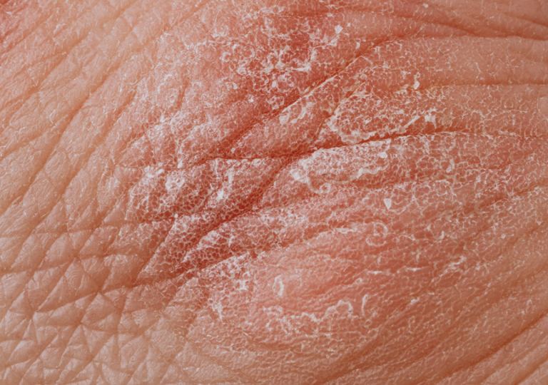 Excessive Dry Skin issues, Symptoms & Treatment - MyMedicPlus